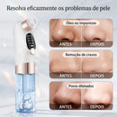 Dermo-Aspirador Hidro-Facial Zynthus: Limpeza Profunda com Tecnologia de Microbolhas