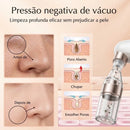 Dermo-Aspirador Hidro-Facial Zynthus: Limpeza Profunda com Tecnologia de Microbolhas